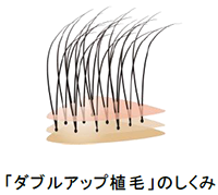 ダブルアップ植毛