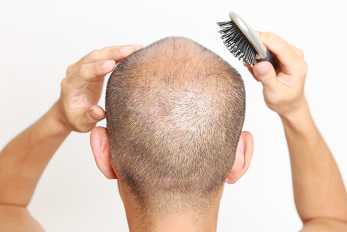 病的脱毛症とは 代表的な種類 カミわざ