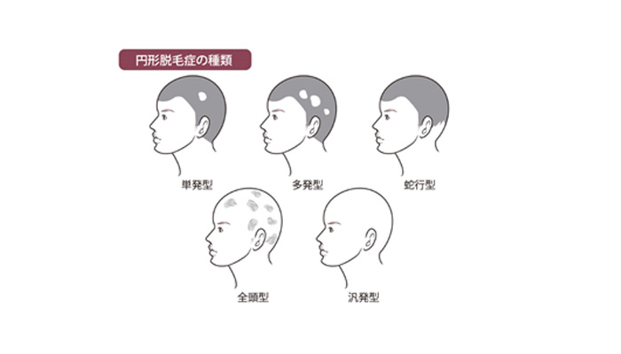 はんぱつ せい 円形 脱毛 症