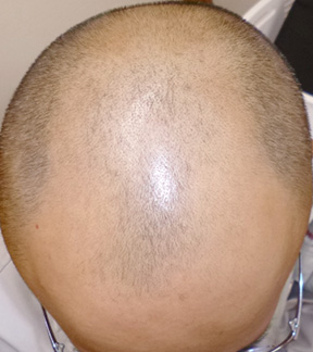 写真　男性脱毛症