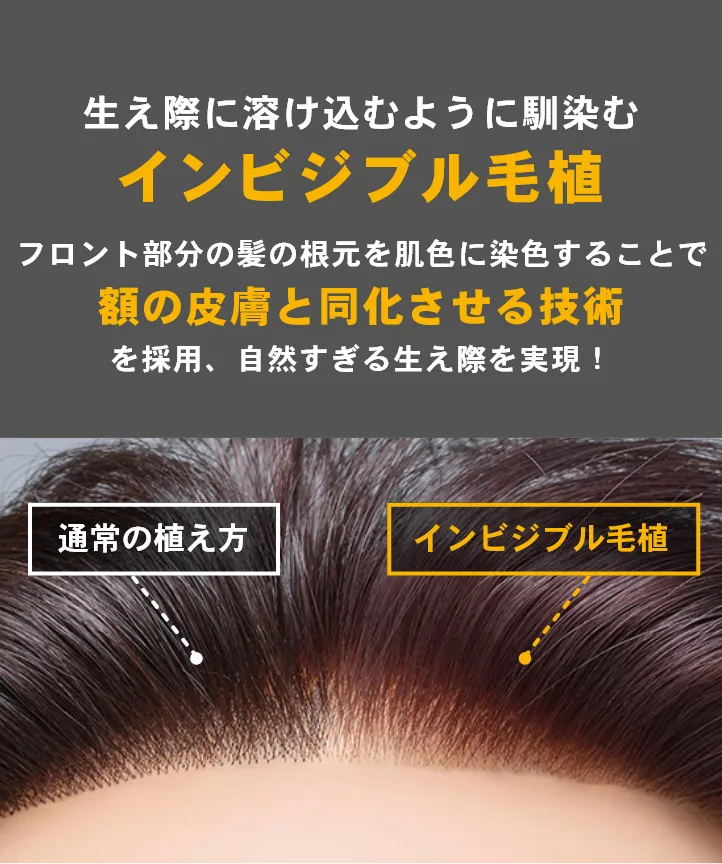 生え際に溶け込むように馴染むインビジブル毛植 フロント部分の髪の根元を肌色に染色することで額の皮膚と同化させる技術を採用、自然すぎる生え際を実現!
